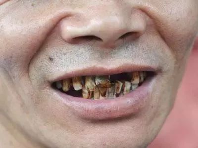 这款美国护牙神器让烟渍,口臭,大黄牙一扫而光!