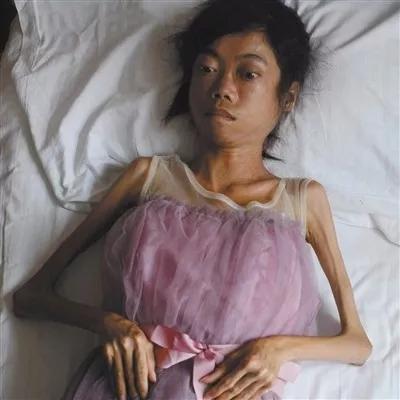 "渐冻人"患者躺在床上.