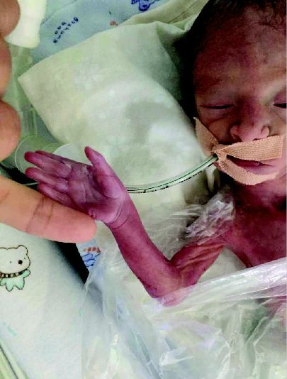 山西最小早产儿康复!这个手掌婴儿出生时仅790克!胎龄只有6个月
