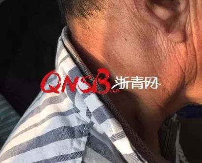 小心耳朵后面长个小疙瘩不痛也不痒上医院一查竟是这么大的病
