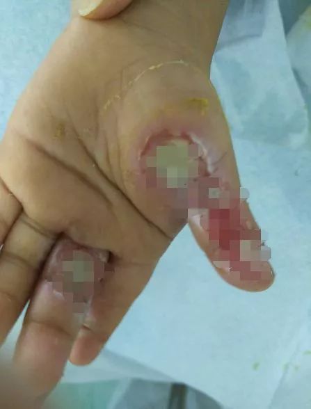 但2岁男童小星(化名)就没有这么幸运了,他被交流电电伤,直接被电晕,进