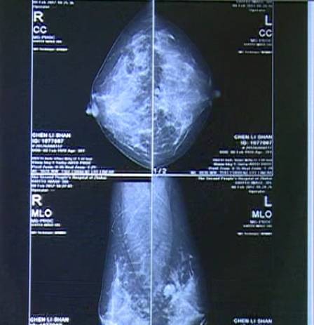乳腺癌报告单图片