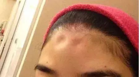 怎么回事老板一啤酒瓶下去姑娘的额头被砸出坑索赔十万闹到警局