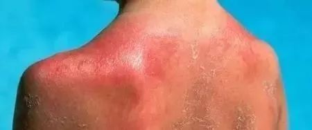 皮肤都被搓红了但也有一些人会选择清洁力超级强的搓澡巾背上就不停的