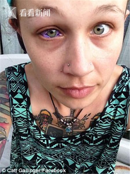 纹眼球失败眼睛肿胀流水睁不开加拿大妙龄女子欲摘除眼球摆脱痛苦 手机新浪网 纹眼球失败眼睛肿胀流水睁不开加拿大妙龄女子欲摘除眼球摆脱痛苦 手机新浪网