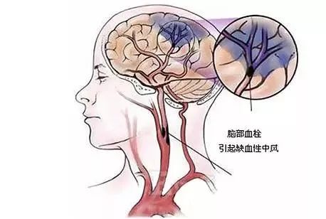 上向前走,如果不能准确踩线或者身体摇晃,表明小脑或者脑干出现问题
