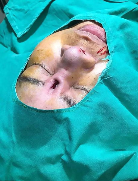 惊恐泰女子隆鼻失败两眼间外露一截硅胶棒