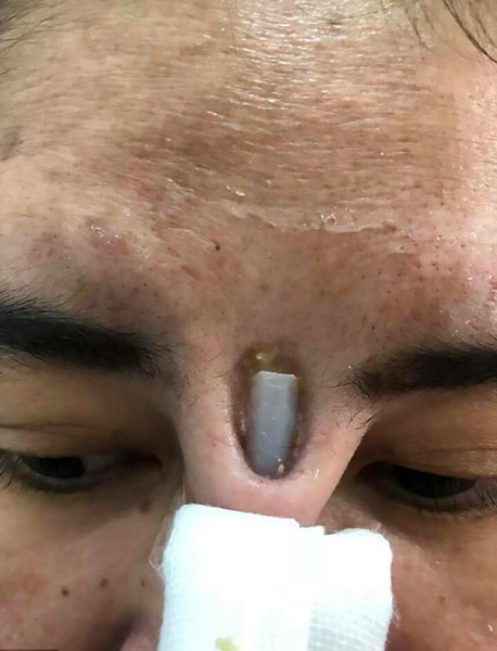 惊恐泰女子隆鼻失败两眼间外露一截硅胶棒