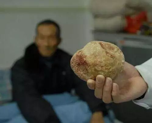 79岁长沙老爹爹胃结石遵医嘱连喝3天可乐奇迹出现了