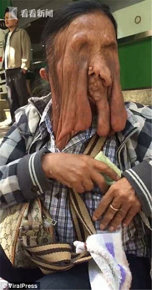 63岁老妇患怪病面部"熔化"坍塌已无人形 坚拒治疗称"怕死在手术台上"