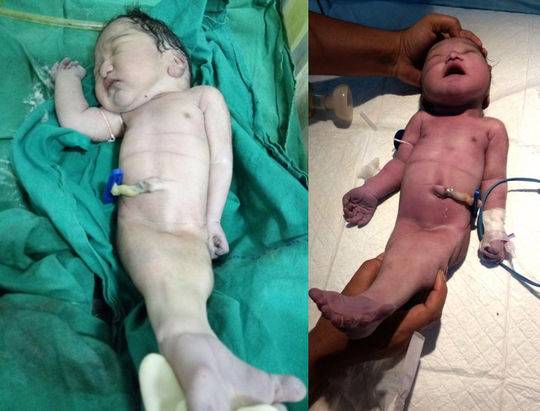 印度妈妈生下现实版"美人鱼" 宝宝4小时后不幸夭折