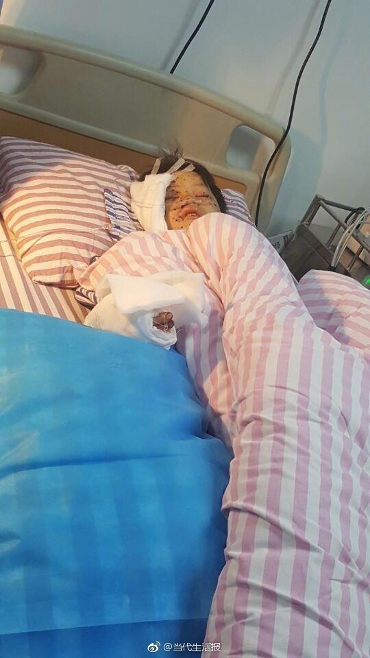 充电手机突然爆炸12岁男孩手指被炸断眼球被炸伤