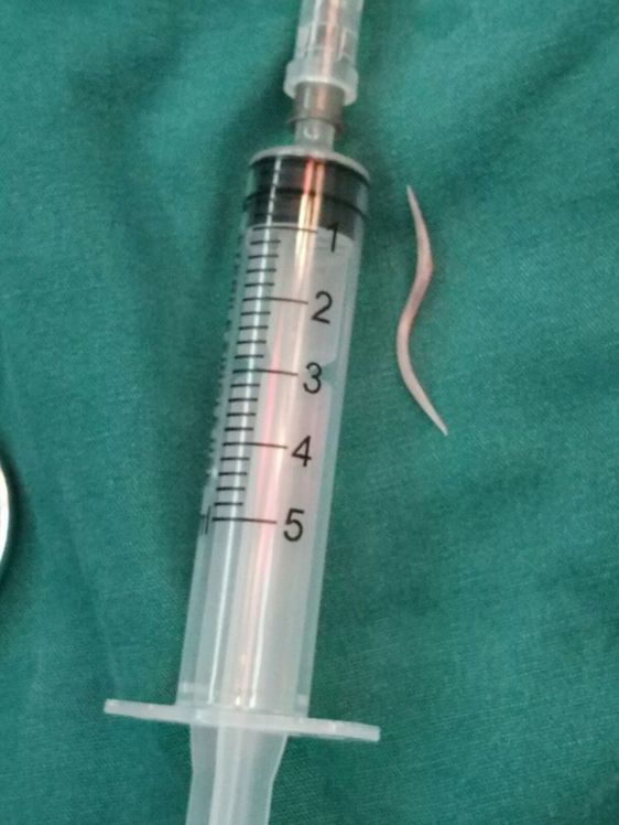 4cm长鱼骨刺穿食道逼近动脉幸亏没做这个动作他才捡回一条命