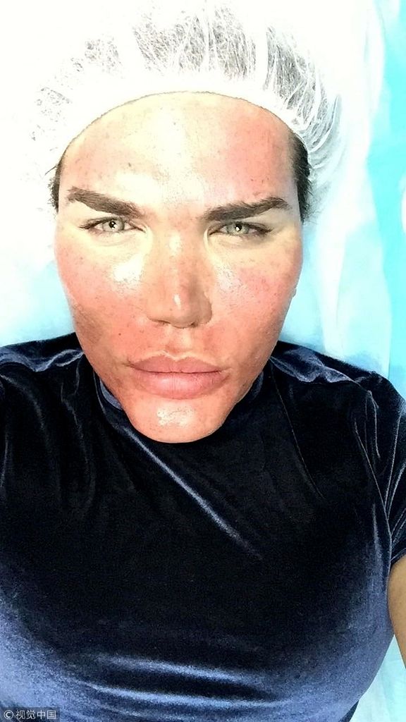 "肯娃娃"阿尔维斯微整形未消肿就出街 顶"猪头脸"吓人