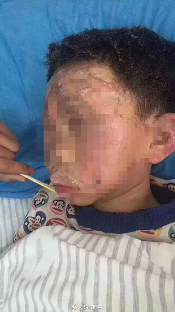 重庆8岁男童疑因喝止撬车牌被泼油烧伤警方回应