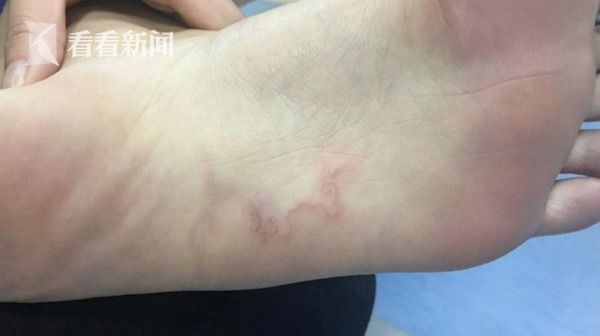 视频|泰国沙滩归来脚底长红线 竟是线虫幼体钻入体内|泰国|旅游|虫子