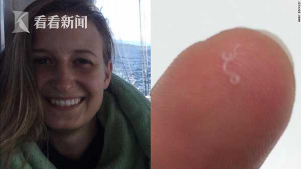 视频 感觉眼睛有异物女子从眼皮里拉出14条寄生虫 手机新浪网