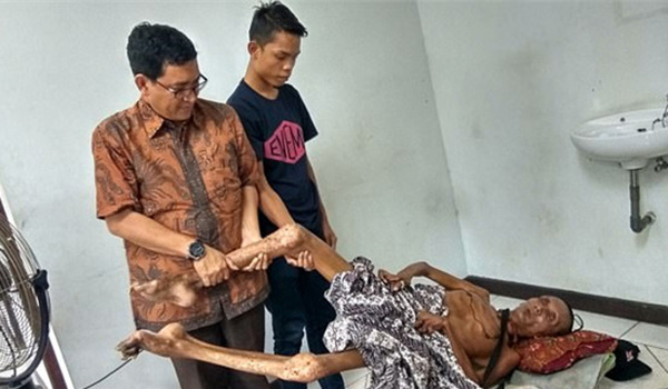 男子避让小狗翻车瘫痪 24年后四肢僵硬如干尸