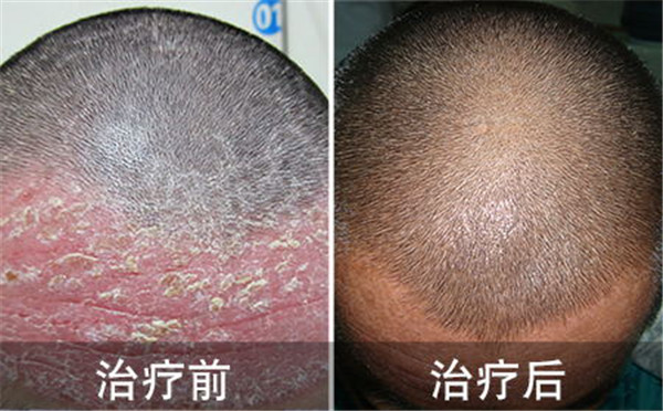 博士通宵赶论文诱发银屑病 辗转5年终在潍坊治愈顽疾