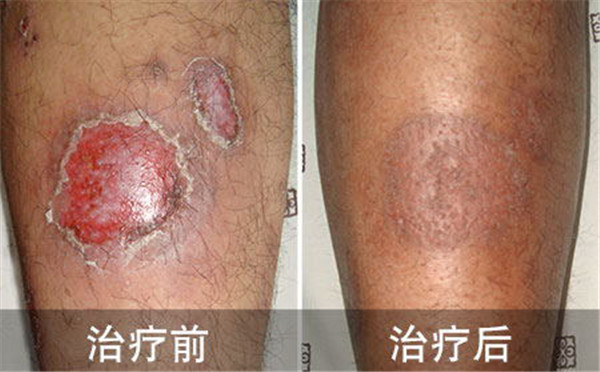 外伤让他患上牛皮癣痛苦6年 一朝治愈开启全新人生阶段