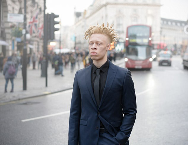 英白化病男孩受尽嘲笑成功逆袭成时尚模特