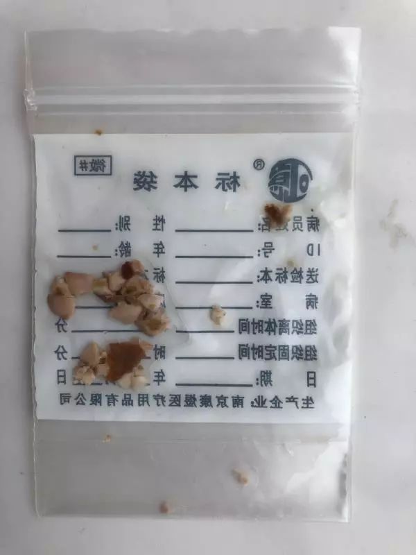 患者数量上升据了解,近年来,异物"误入"儿童食道,气道事件频频发生