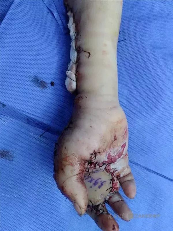 用正在充电手机玩游戏发生爆炸,南宁 8 岁男孩手被炸烂