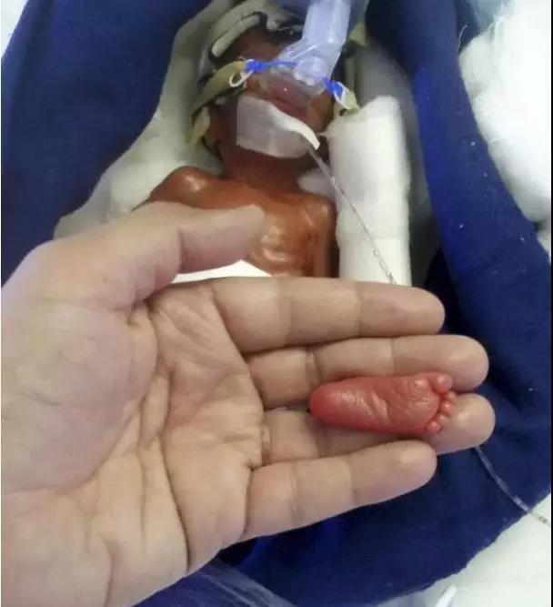 印度巴掌女婴出生时仅08斤脚还没爸爸的拇指大