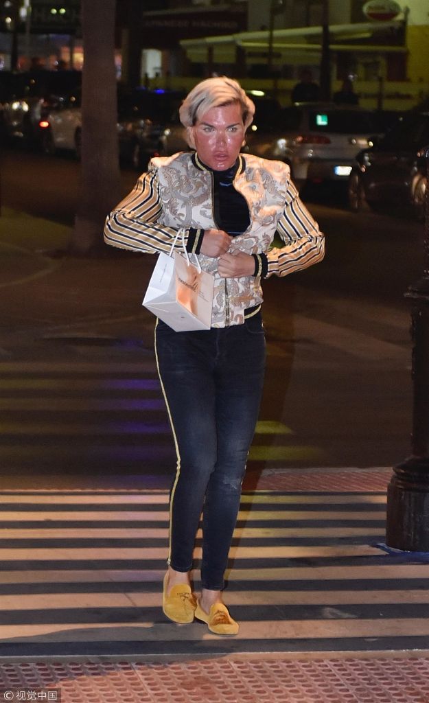 "肯娃娃"阿尔维斯微整形未消肿就出街 顶"猪头脸"吓人