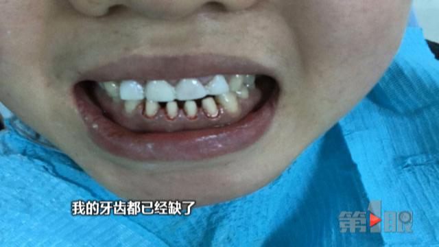 崩溃女子嫌门牙有缝去咨询八颗牙被磨成小米粒