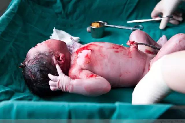 100张剖腹产过程照片,看哭了所有人!|手术|剖腹产|伤口_新浪新闻