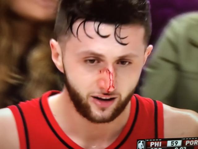 努尔基奇谈鼻子受伤:我依旧很可爱