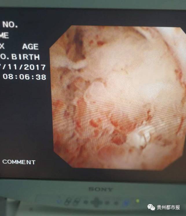 惠水一男子出现这种症状差点丢命|上火|肾癌|肿瘤_新浪新闻