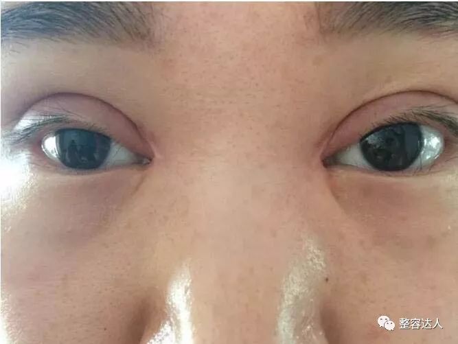 细数8种失败的双眼皮有你吗