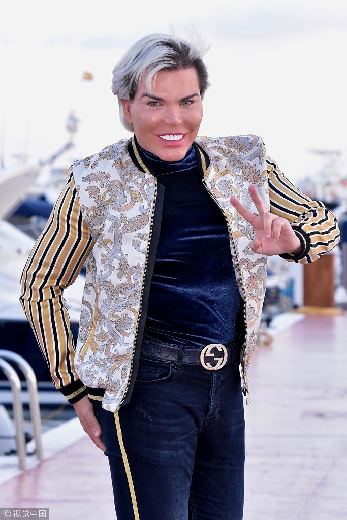 "肯娃娃"阿尔维斯微整形未消肿就出街 顶"猪头脸"吓人