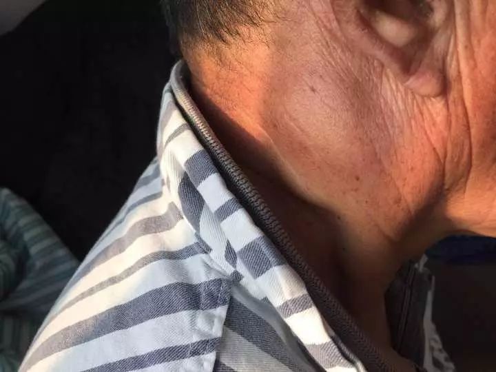 男子耳后长小疙瘩不在意 半年后检查已变癌症(图)|肺癌|淋巴结|疙瘩