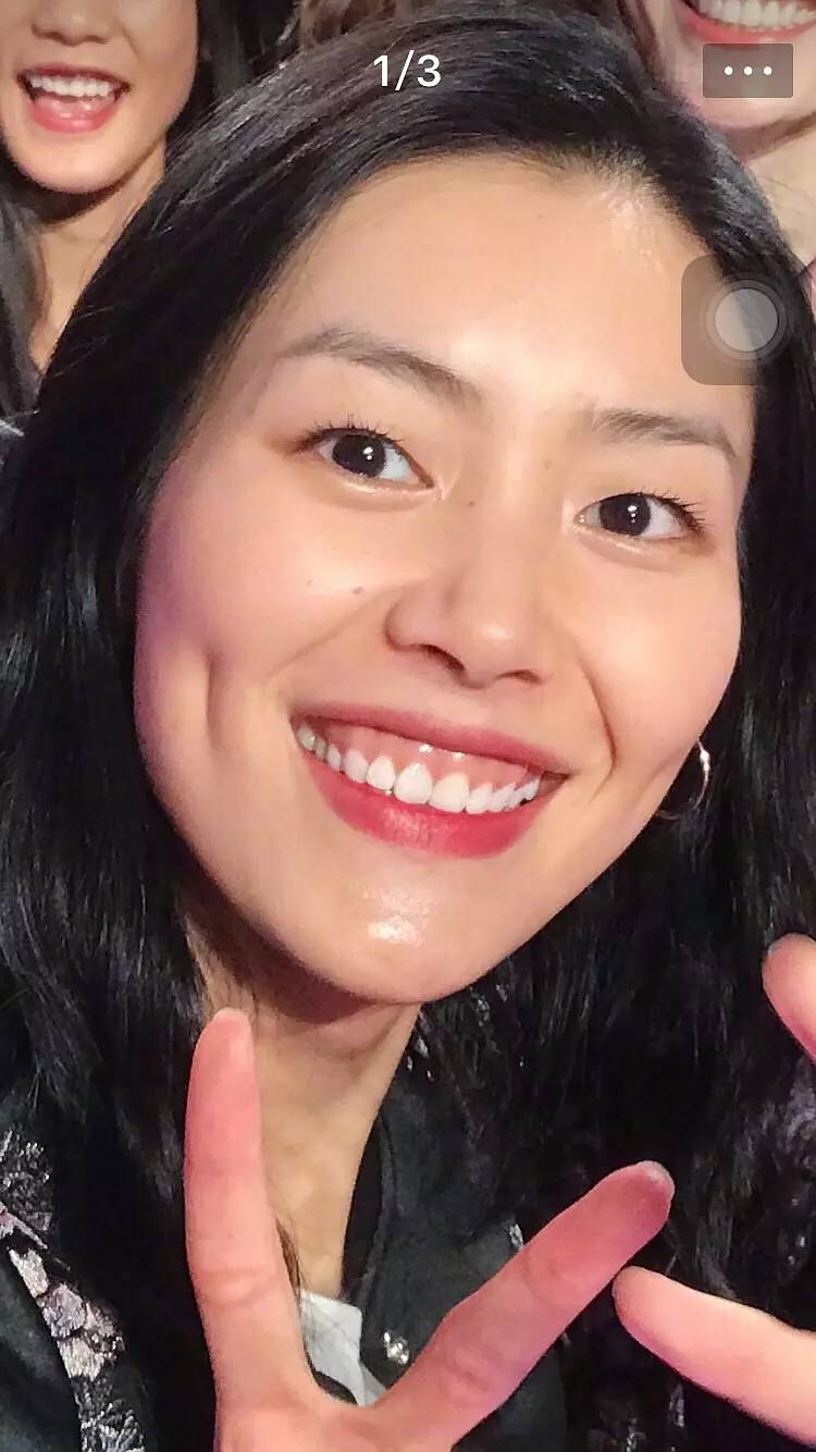 刘雯为了拯救她的露龈笑竟然在嘴里打支抗钉