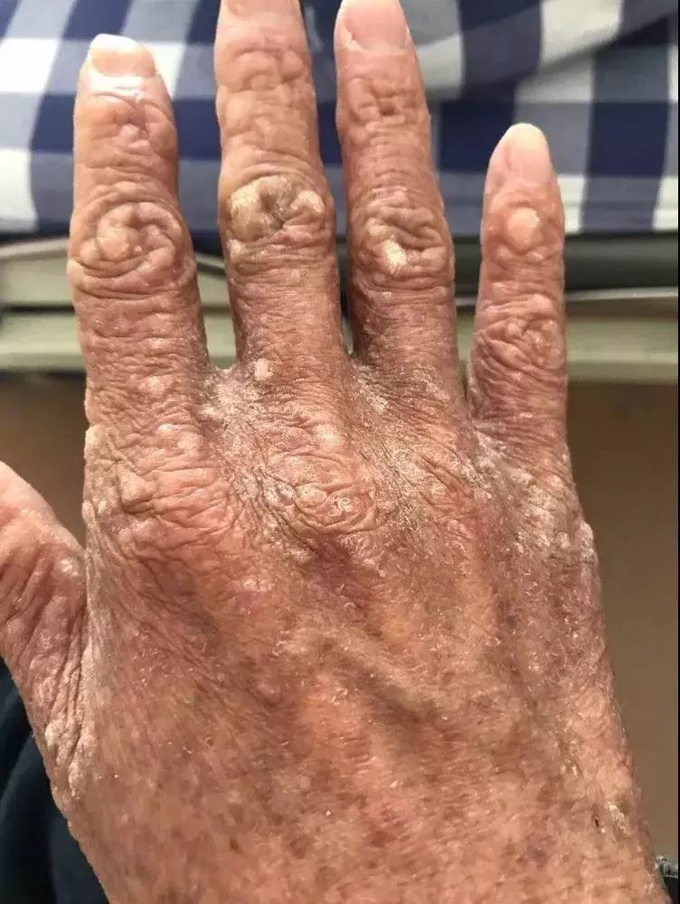 15年啊 结果 毒没解 人反倒中毒 26岁的人 皮肤看起来像80岁 多器官