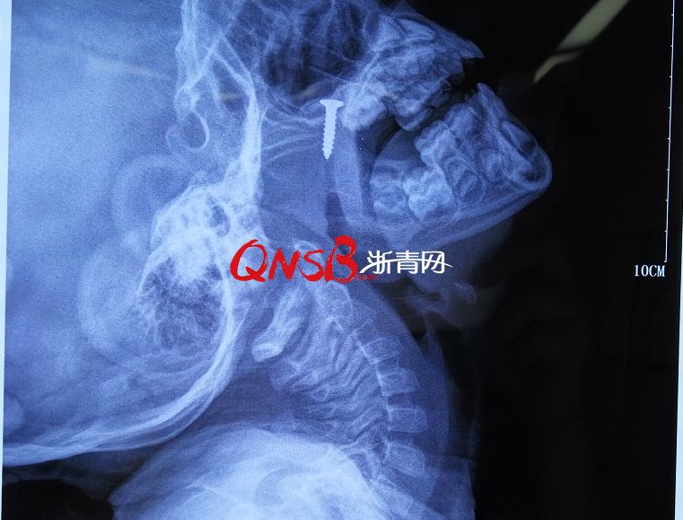 医生从他身上取出了这东西…|鼻窦炎|打鼾|鼻腔_新浪新闻