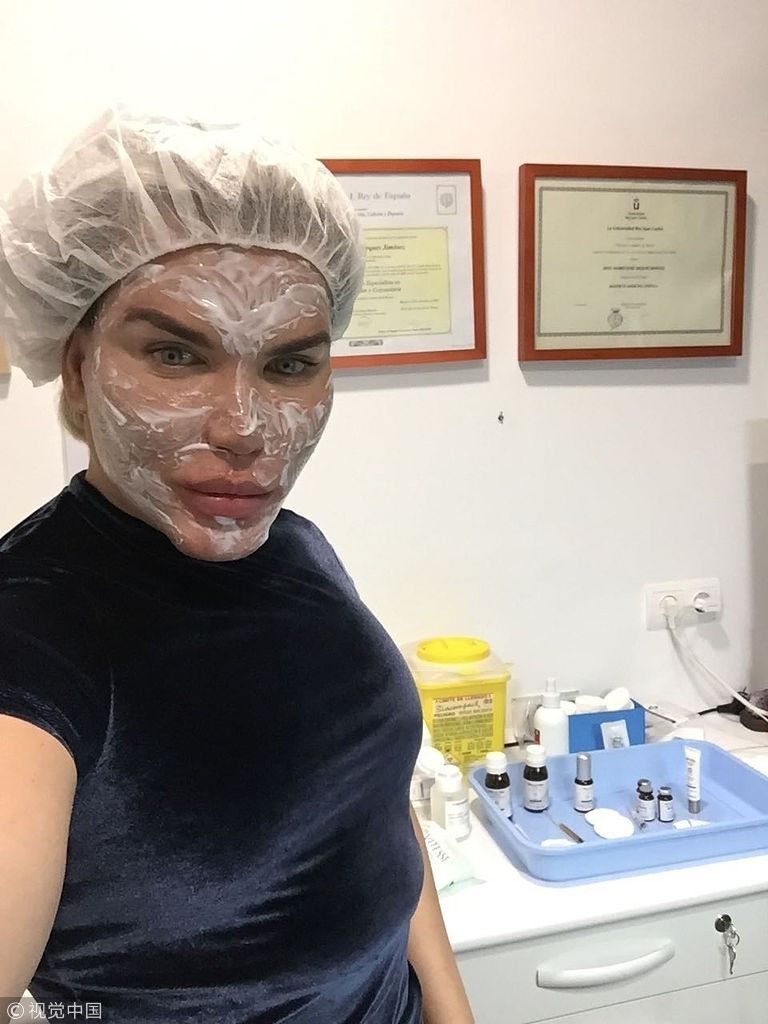 "肯娃娃"阿尔维斯微整形未消肿就出街 顶"猪头脸"吓人