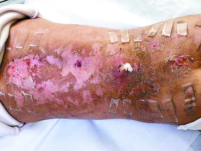 虐心9岁女孩不去上学还遍体鳞伤家长的态度却