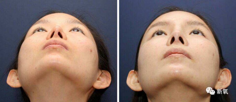 承受压力大一侧的鼻翼软骨较低造成两侧鼻翼,鼻孔不对称