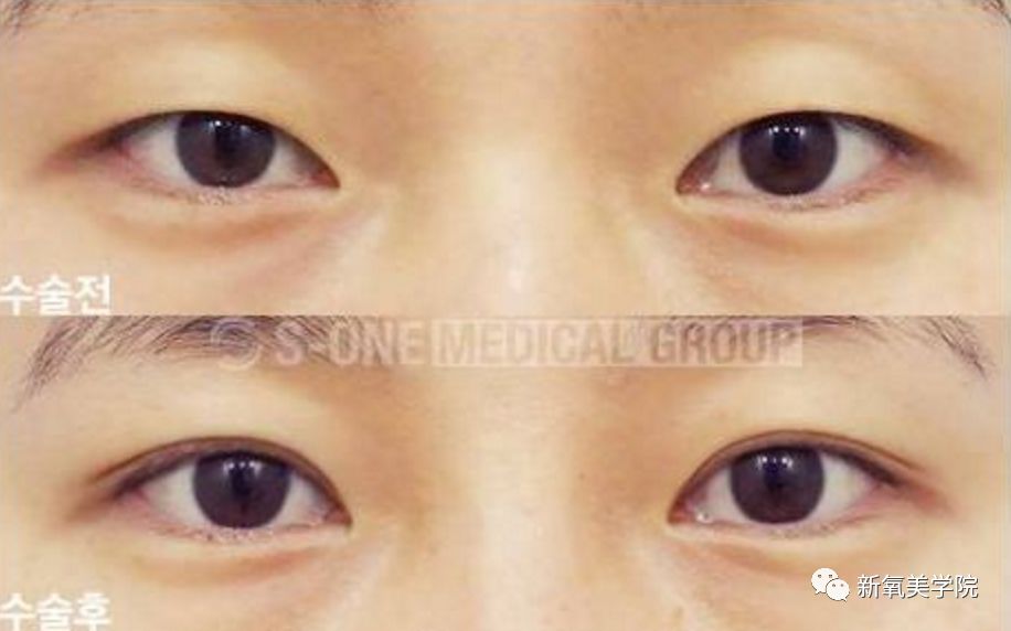 在不开眼角的情况下,双眼皮会增加眼睛的高度,从而增大眼睛.