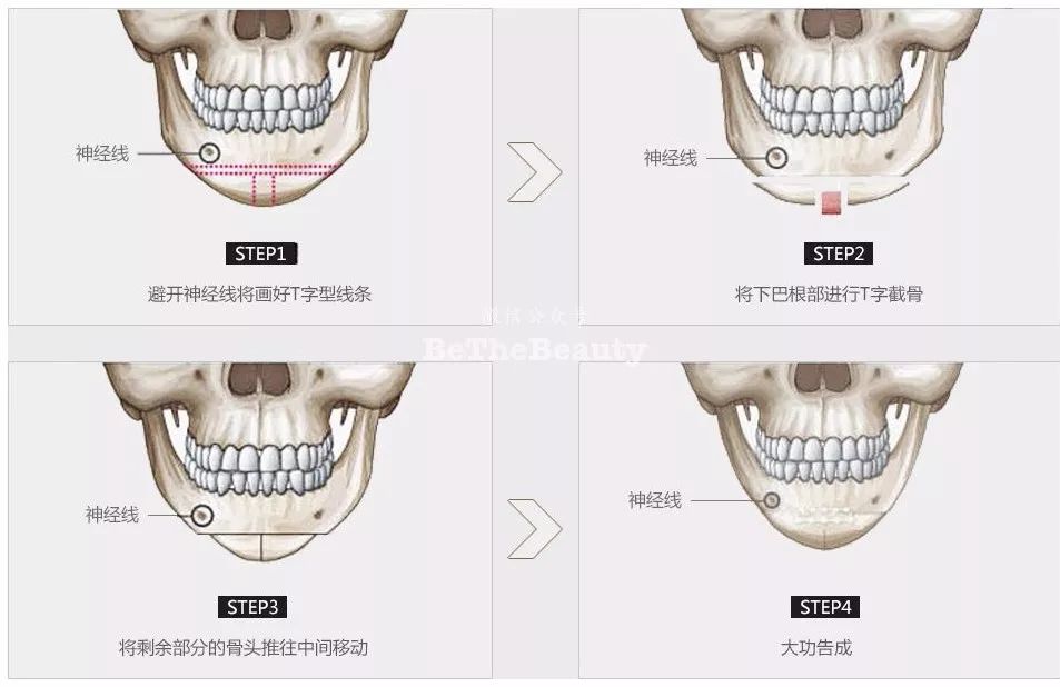 加个尖下巴就会变美?可为什么有人加了精致又