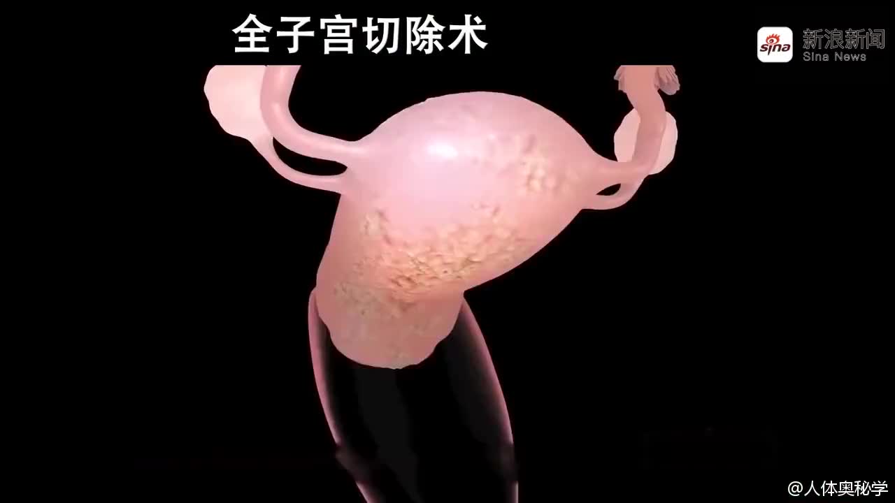3d动画:机器人辅助腹腔镜子宫切除术