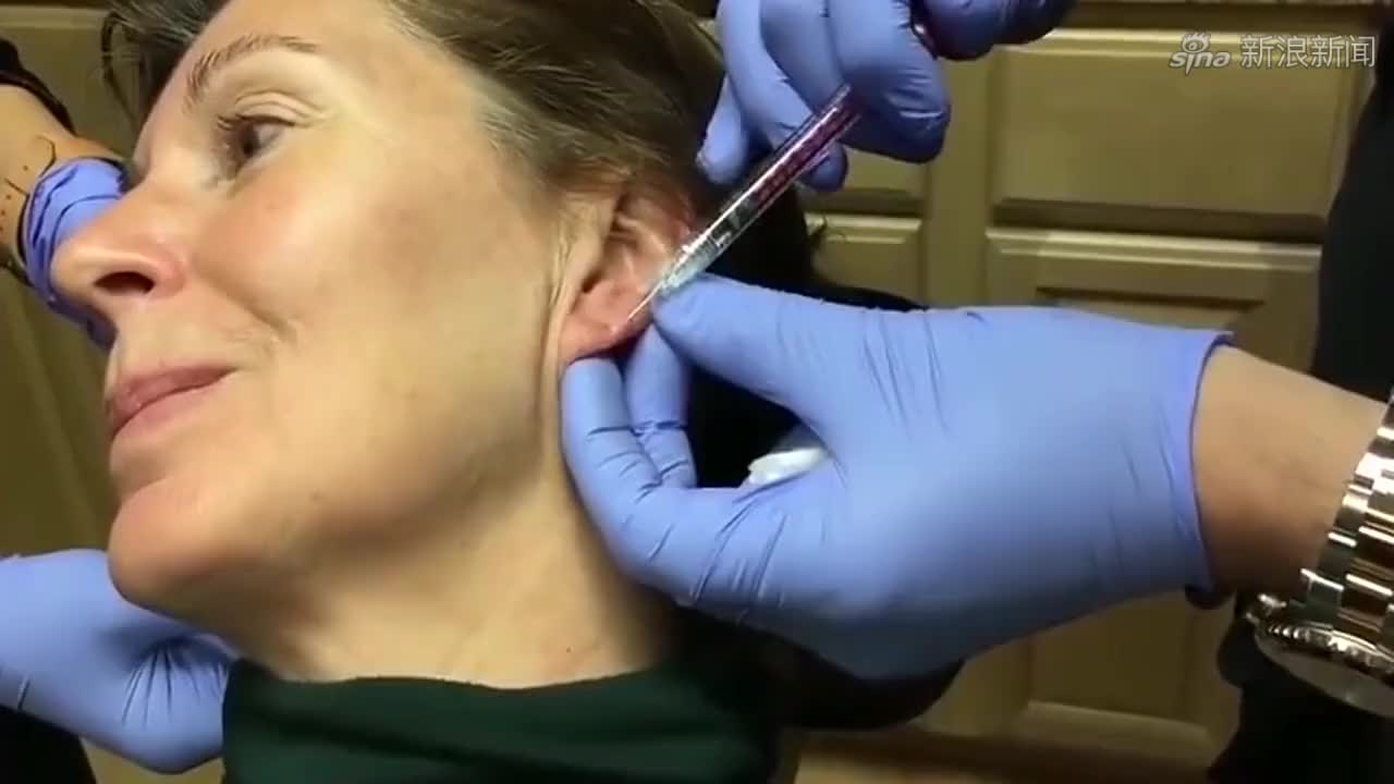 老奶奶整容给耳朵打玻尿酸,看着都疼,不过打完以后真有效果