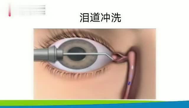 先天性泪道阻塞的诊断与治疗