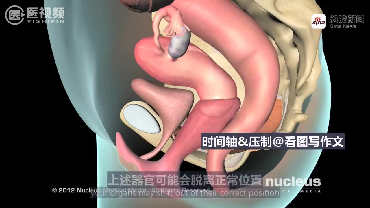 医学双语科普:子宫托