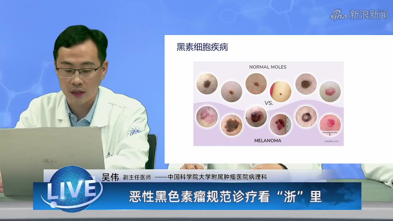 恶性黑色素瘤规范诊疗看"浙"里