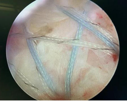 肩关节镜下肩袖损伤修补